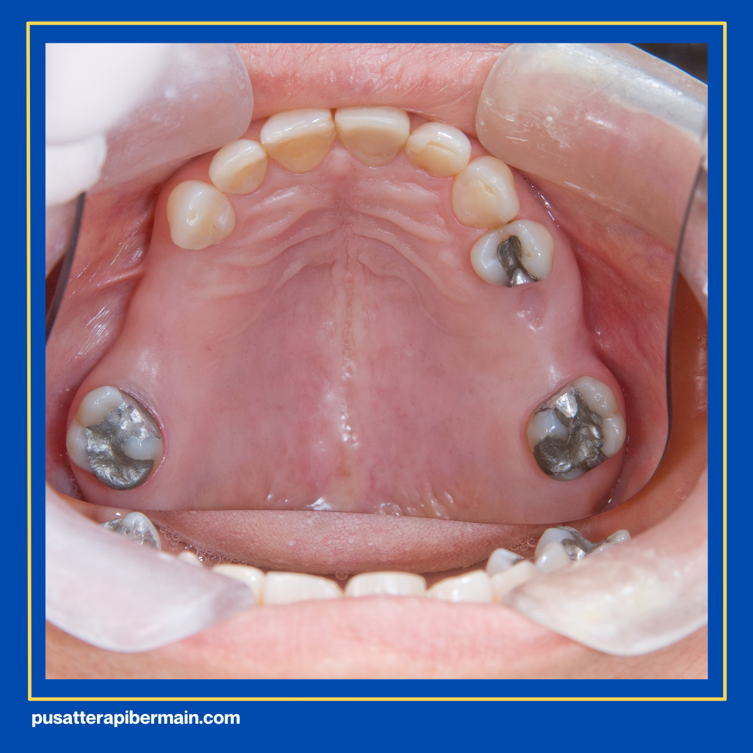 penyebab speech delay